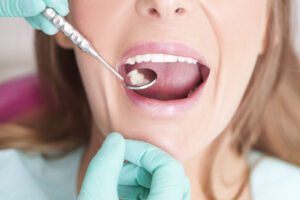 Dentures Decay Tooth Filling