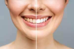 Teeth Whitening Brenchley