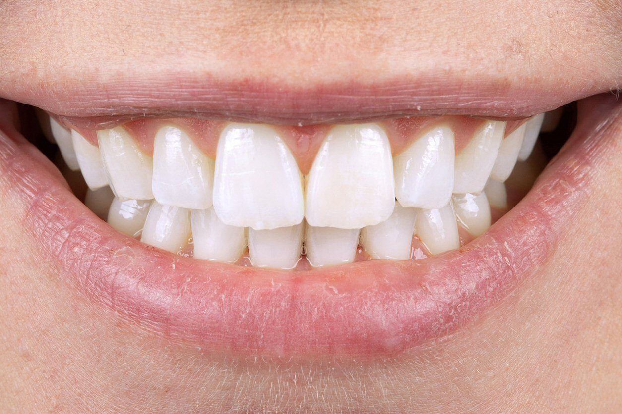 Boutique whitening