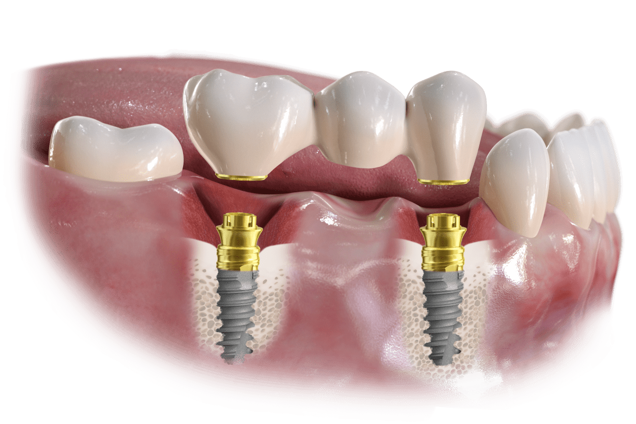 Dental implants