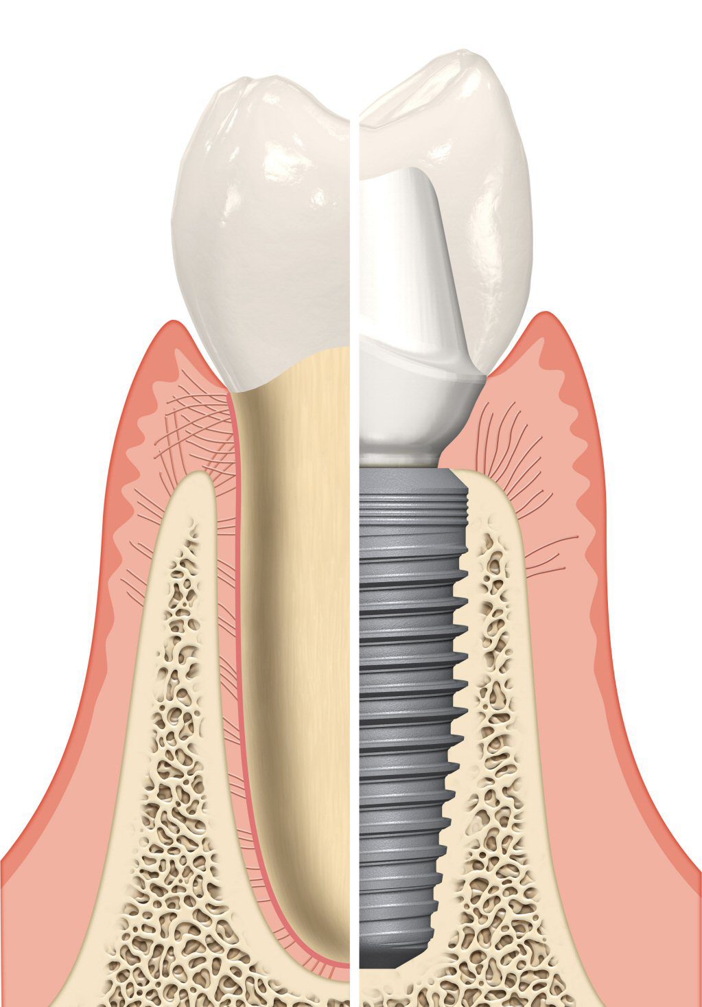Implants 2